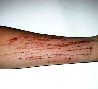 scratches